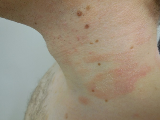 Pityriasis Rosea: Cause Versus Trigger—and How PrrEze Can Help