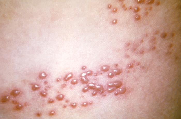Understanding Shingles: Prevention and Relief with Shingles Stop