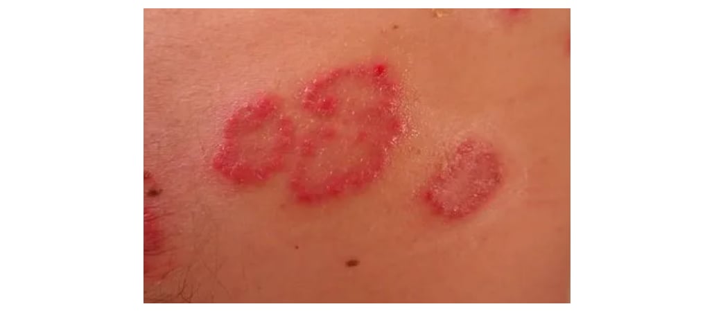 Treatment Of Shingles Virus